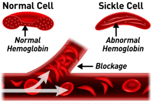 Sickle-Cell